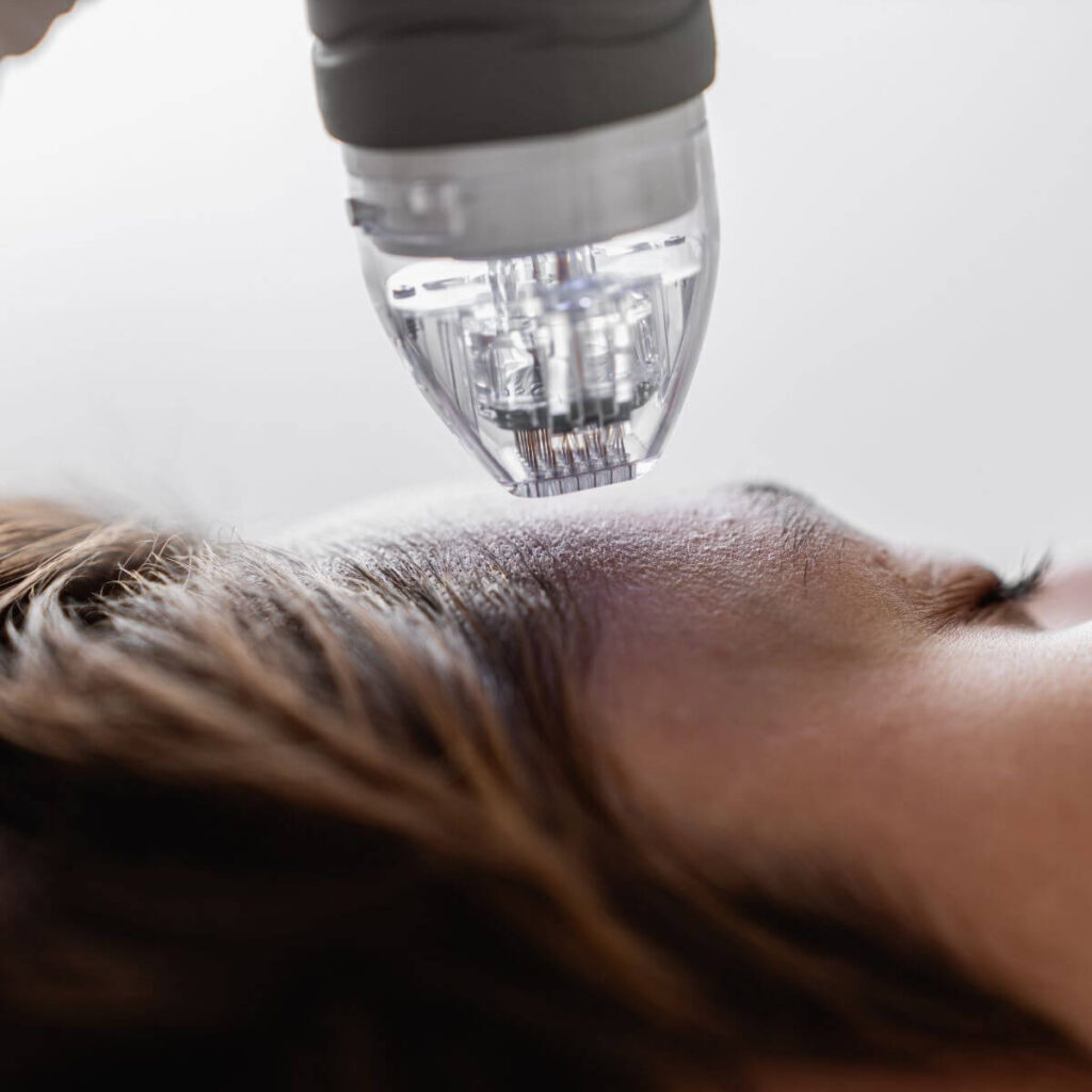 Microneedling in Bad Breisig Jugendliche Haut durch Microneedling in Bad Breisig